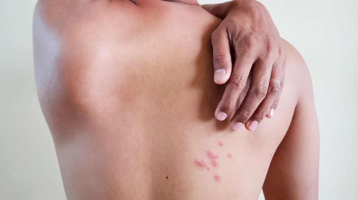 What is the First Sign of Shingles?