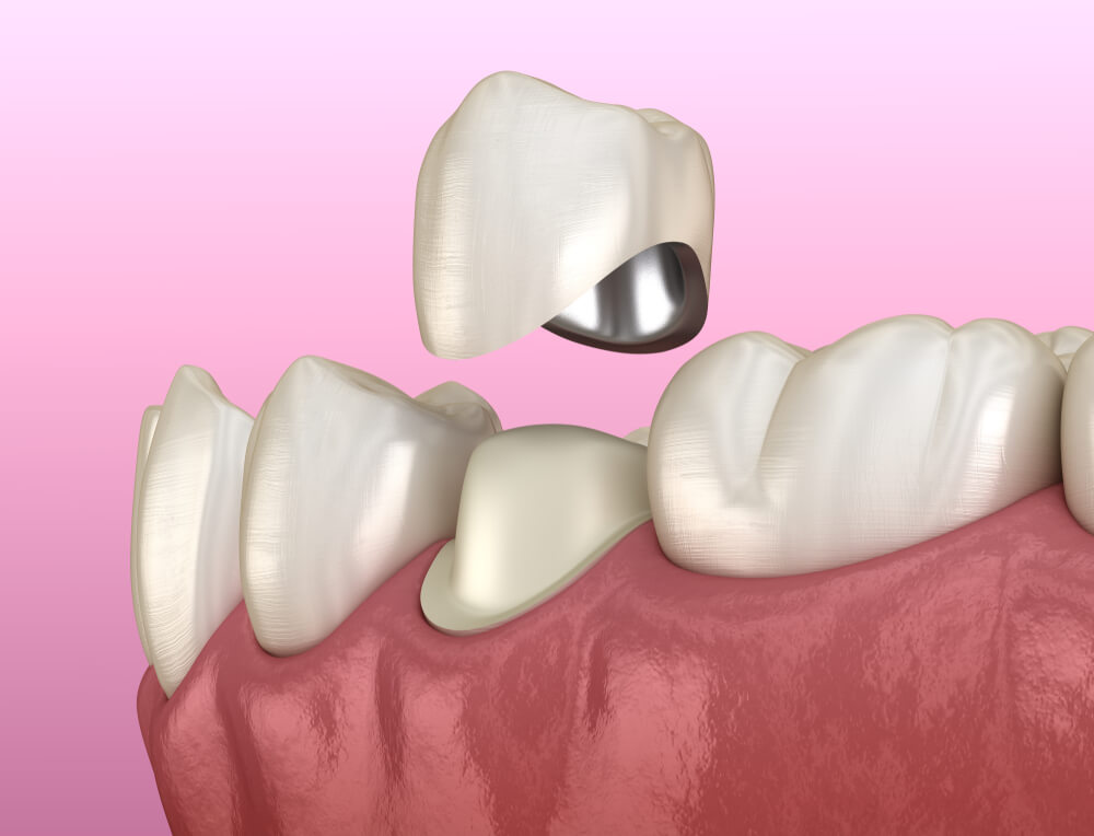Porcelain Crowns: The Art Behind Durability and Aesthetics 