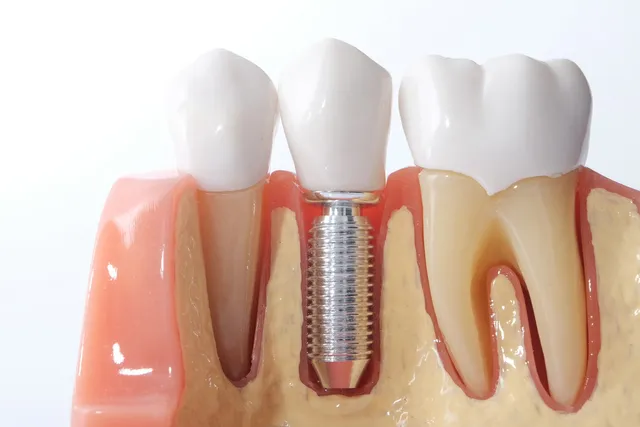 What Are Zygomatic Implants And What Are Its Benefits?