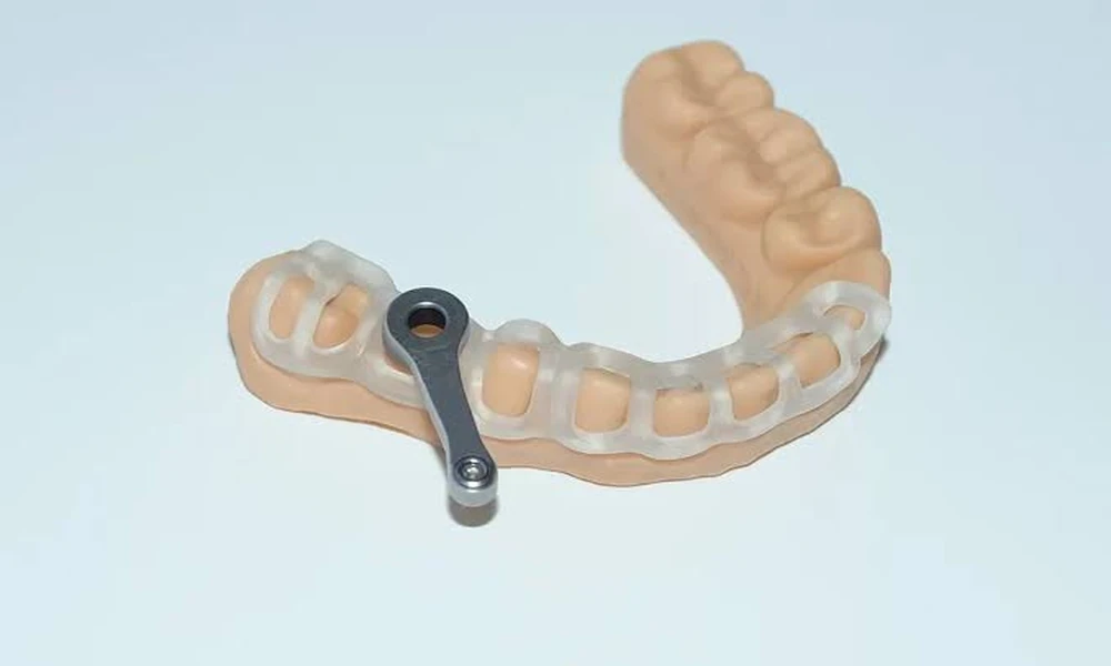 Signs It Is Time to Consider Precision-Guided Dental Implants in Saratoga Springs